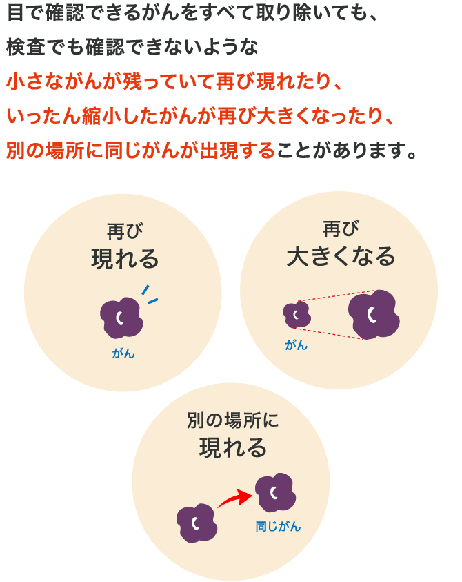 目で確認できるがんをすべて取り除いても、検査でも確認できないような小さながんが残っていて再び現れたり、いったん縮小したがんが再び大きくなったり、別の場所に同じがんが出現することがあります。